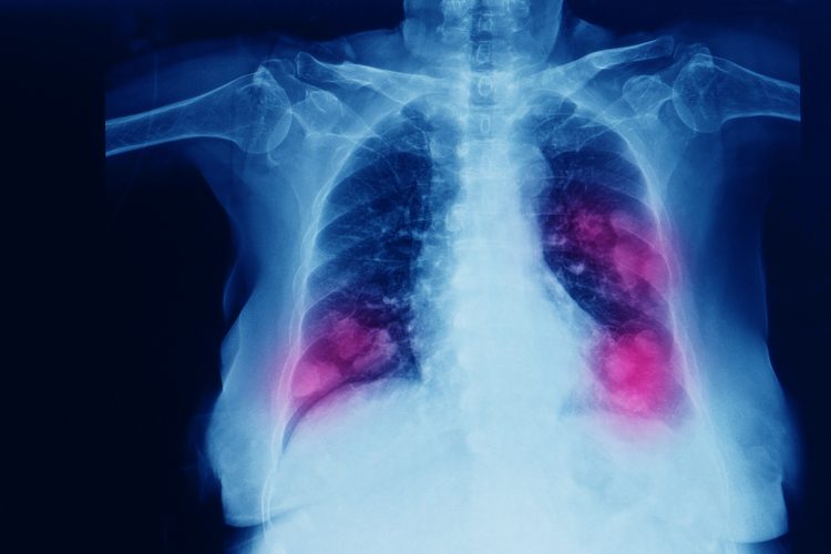 chest imaging showing cancer metastases in both of the lungs