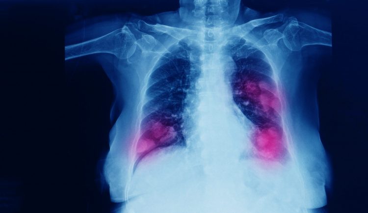 chest imaging showing cancer metastases in both of the lungs