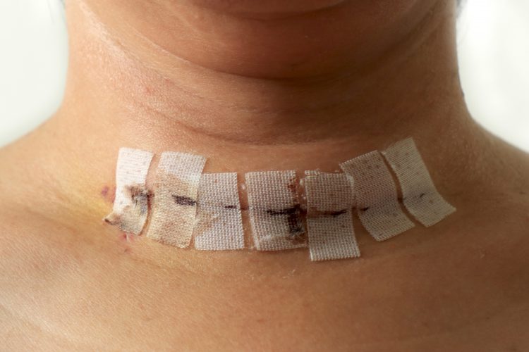 neck with surgical scar - removal of tumour