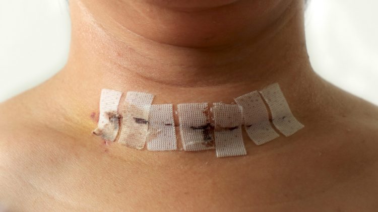neck with surgical scar - removal of tumour