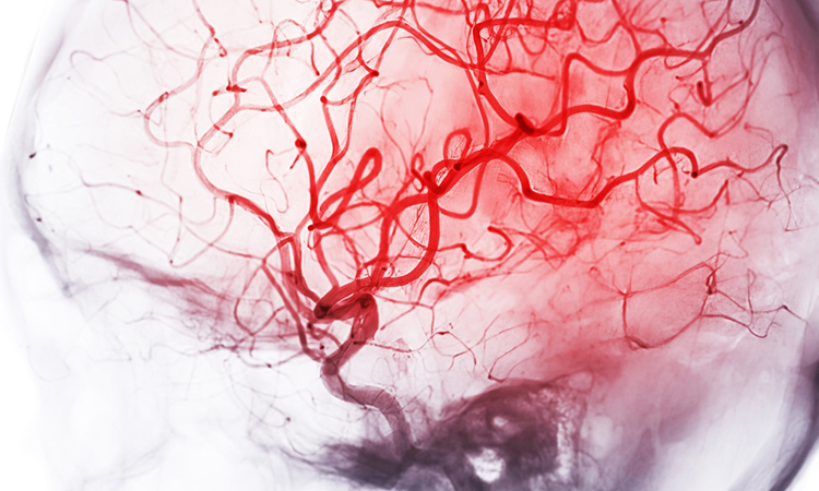 cerebrovascular disease