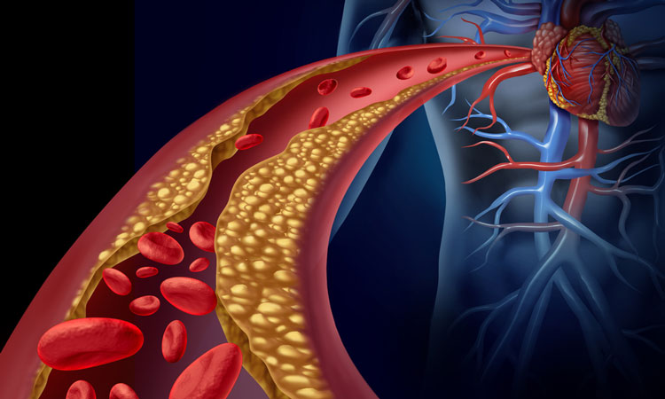 cholesterol