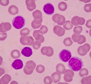 Leukaemia cells