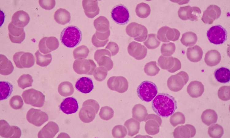 Leukaemia cells