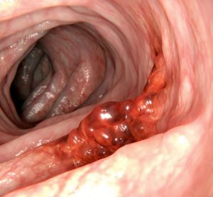 colon cancer