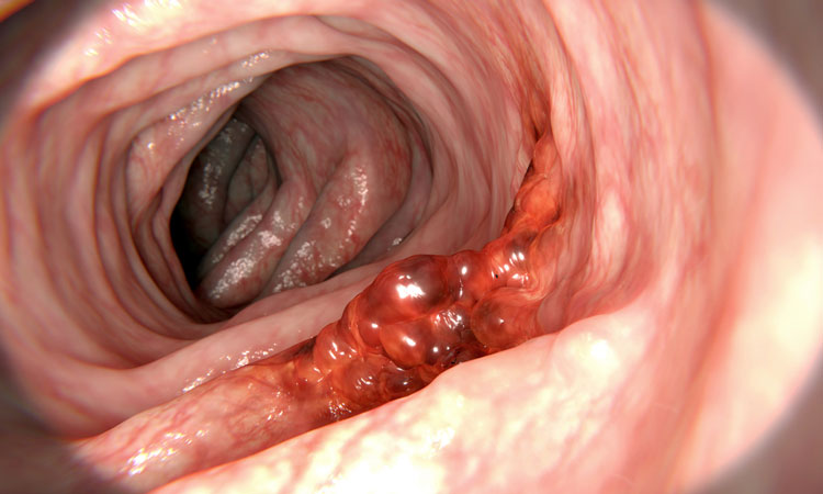 colon cancer