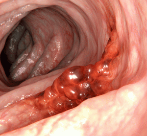 colorectal cancer
