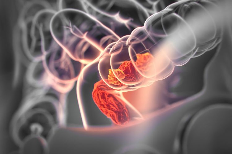 CAR-T immunotherapy