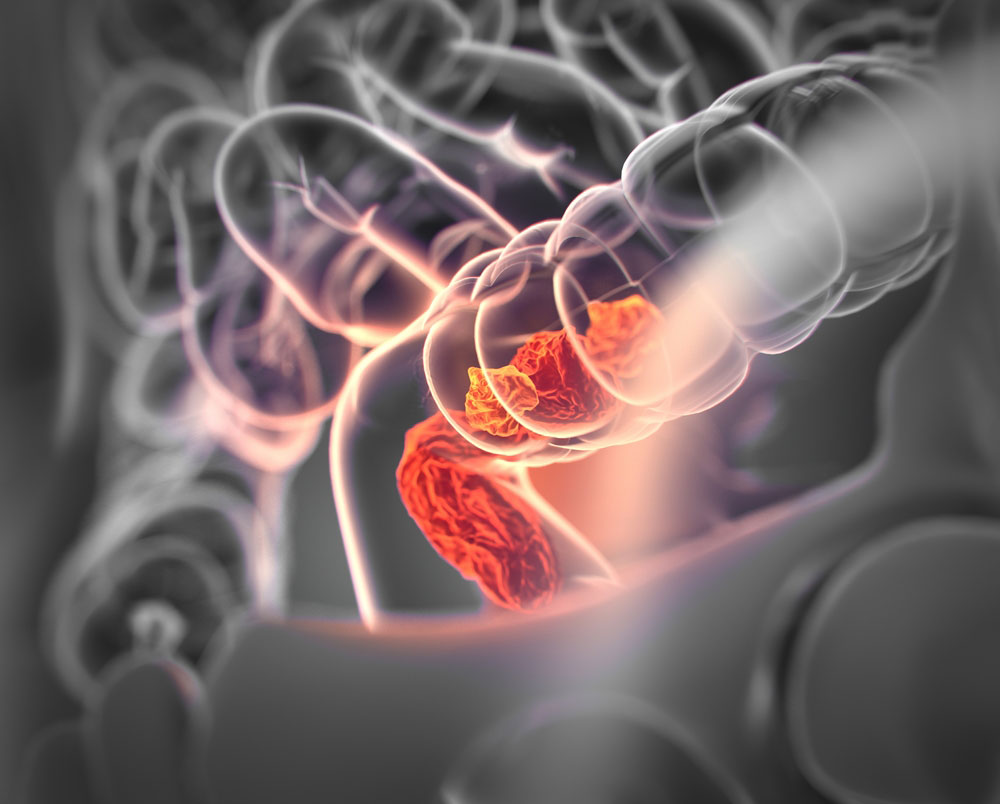 CAR-T immunotherapy