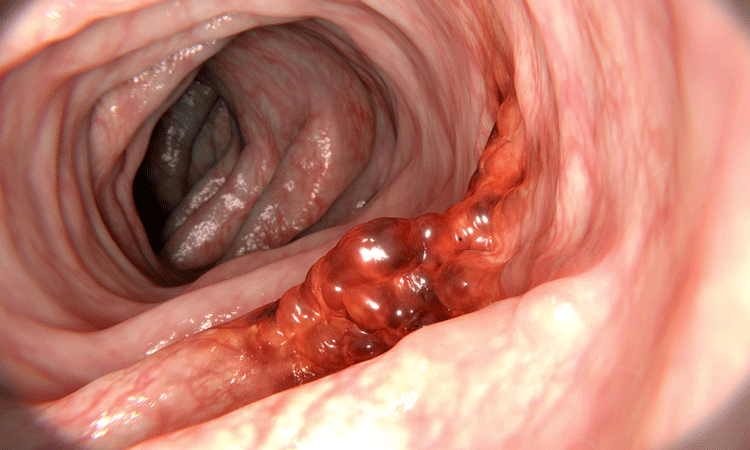 colorectal cancer