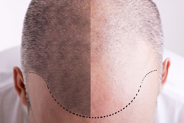 Gene responsible for hair loss discovered - Drug Target Review