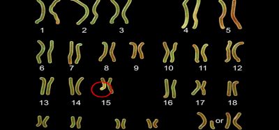 Karyotype of Angelman syndrome, labelled 3D illustration. A genetic disorder caused by a lack of function of part of chromosome 15 inherited from a person's mother