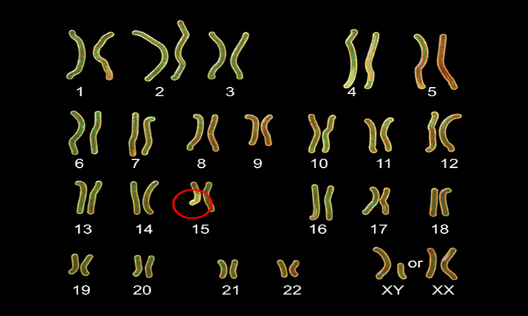Karyotype of Angelman syndrome, labelled 3D illustration. A genetic disorder caused by a lack of function of part of chromosome 15 inherited from a person's mother