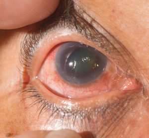New directions found in understanding, fighting glaucoma