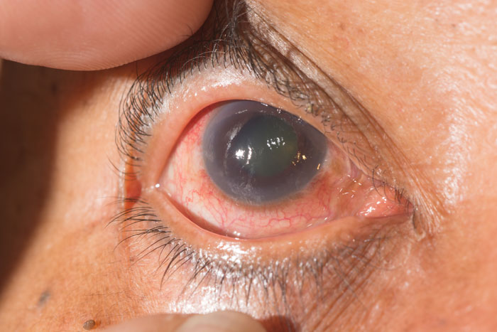 New directions found in understanding, fighting glaucoma