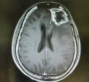 MRI of a glioblastoma in the brain of a patient (in frontal lobe near the right eye)
