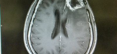 MRI of a glioblastoma in the brain of a patient (in frontal lobe near the right eye)