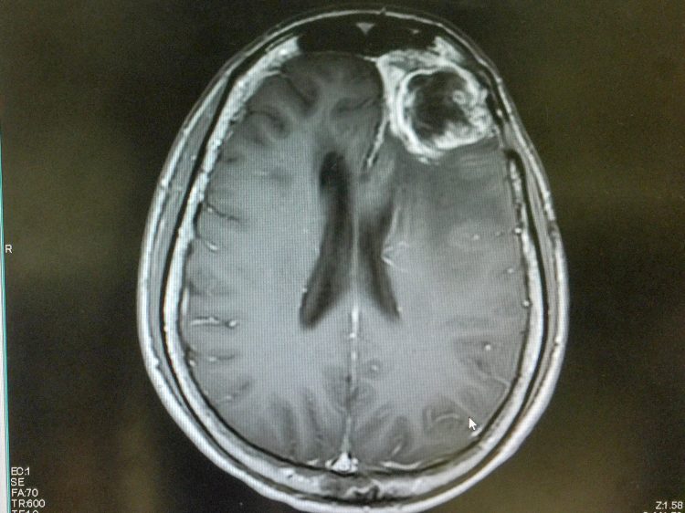 MRI of a glioblastoma in the brain of a patient (in frontal lobe near the right eye)