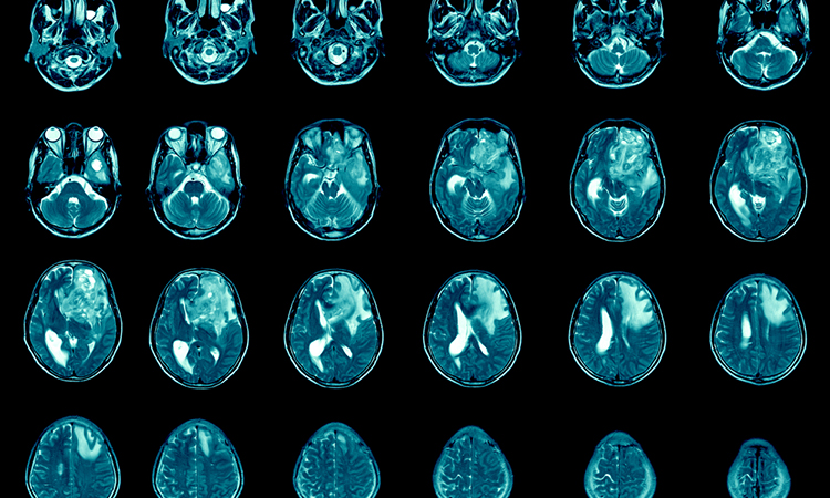Magnetic resonance imaging Finding 5 cm isodense mass with ill-defined margin and surrounding edema at Left frontal lobe.