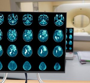 Magnetic resonance imaging Finding 5 cm isodense mass with ill-defined margin and surrounding edema at Left frontal lobe. Glioblastoma, brain metastasis.science and education mri brain background.