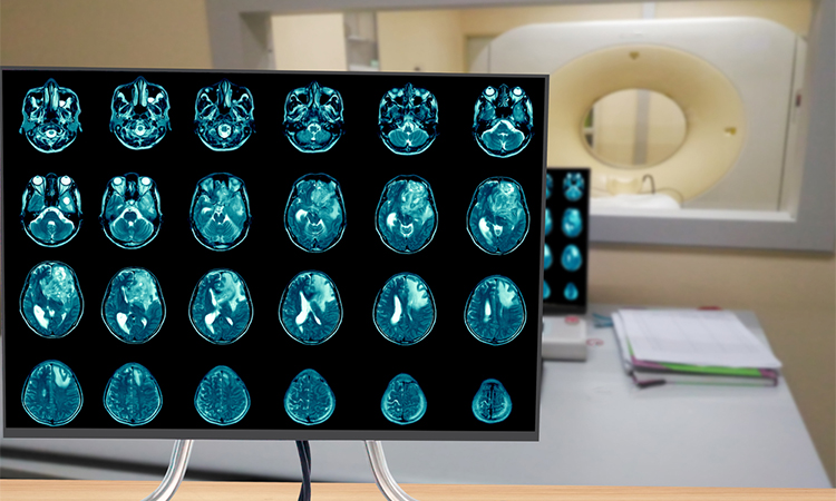 Magnetic resonance imaging Finding 5 cm isodense mass with ill-defined margin and surrounding edema at Left frontal lobe. Glioblastoma, brain metastasis.science and education mri brain background.