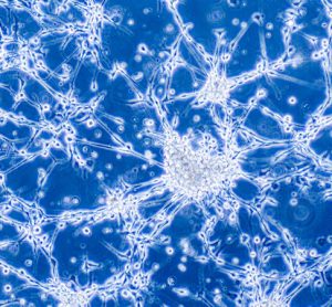 glioblastoma