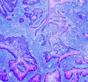 glioma
