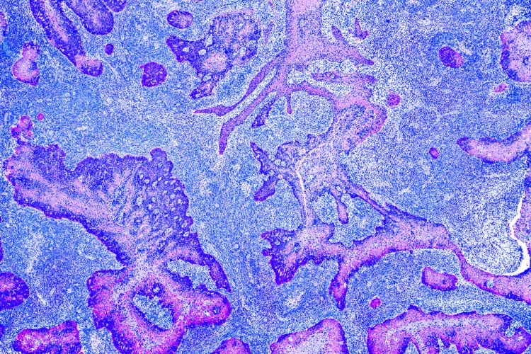 glioma