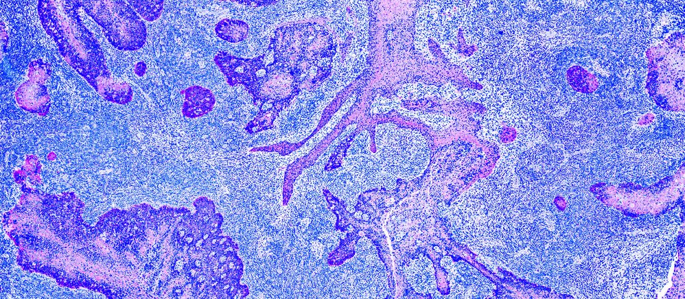 glioma