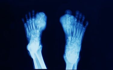 X-ray of feet with bones of the big toes severely degraded by gout