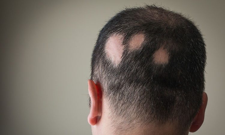 A wearable device for hair regrowth - Drug Target Review