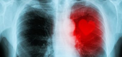 cardiovascular disease