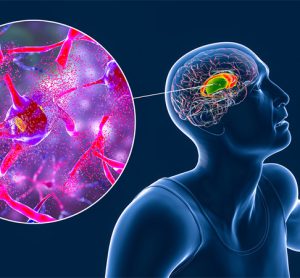 Dorsal striatum, caudate nucleus and putamen, highlighted in the brain of a person with Huntington's disease and close-up view of neuronal degradation, conceptual 3D illustration