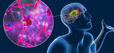 Dorsal striatum, caudate nucleus and putamen, highlighted in the brain of a person with Huntington's disease and close-up view of neuronal degradation, conceptual 3D illustration