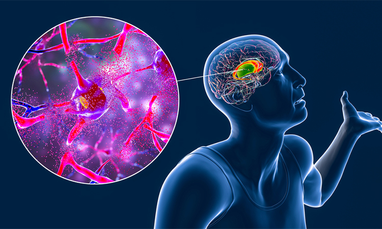 Dorsal striatum, caudate nucleus and putamen, highlighted in the brain of a person with Huntington's disease and close-up view of neuronal degradation, conceptual 3D illustration