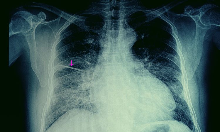 ischemic cardiomyopathy