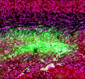 Even after a blocked vessel has been opened, immune cells in the brain (green) continue to attack synapses (red) and neurons (magenta) in the memory center of the brain, the hippocampus, for at least 30 days after stroke.