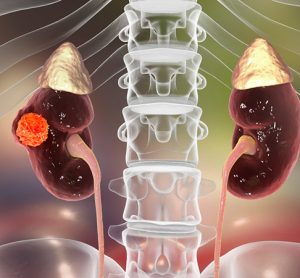 kidney cancer, 3D illustration showing presence of cancerous tumour inside kidney tissue
