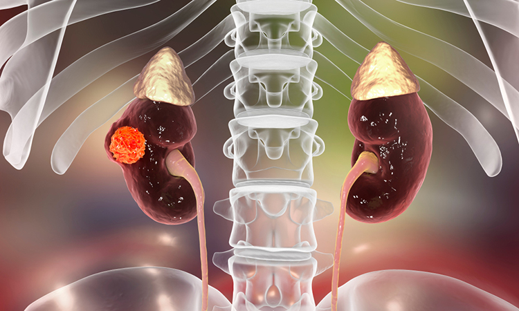 kidney cancer, 3D illustration showing presence of cancerous tumour inside kidney tissue