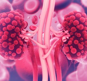 DNA sequencing for kidney disease