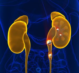kidney stones