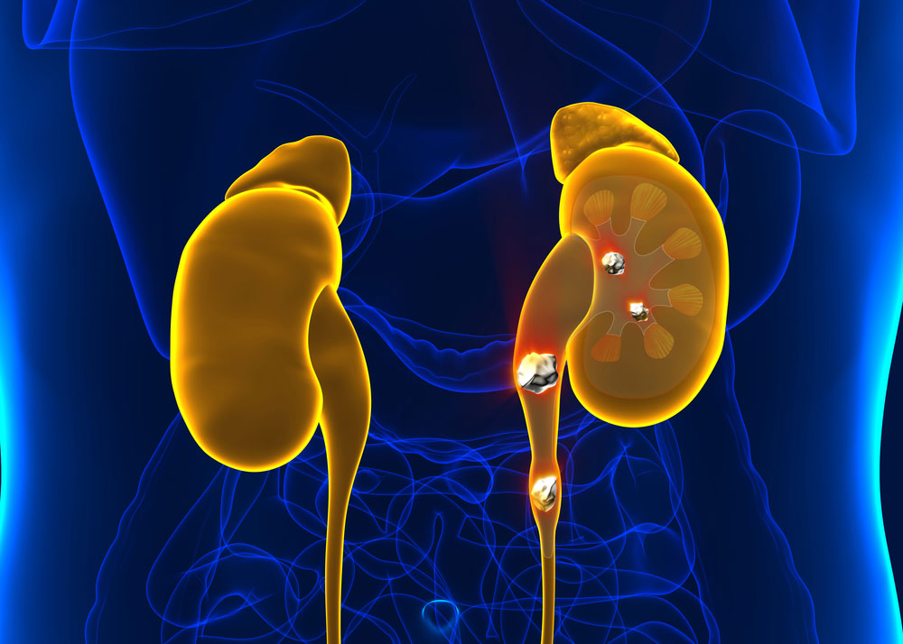 kidney stones