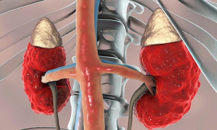 nephrotic