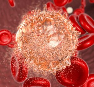 MPAL-rare-leukaemia