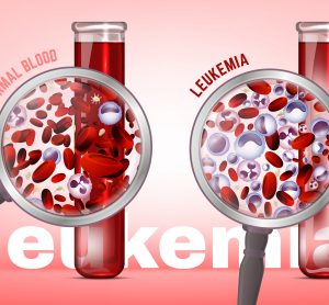 comparison of normal and leukaemic blood - leukaemia results in blood with a larger proportion of white blood cells and fewer red blood cells