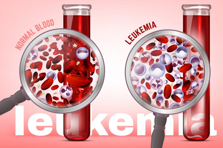 comparison of normal and leukaemic blood - leukaemia results in blood with a larger proportion of white blood cells and fewer red blood cells