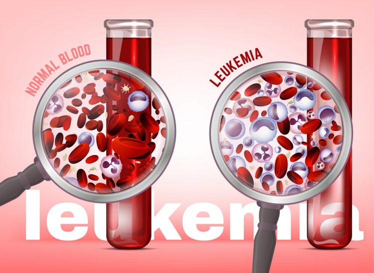 comparison of normal and leukaemic blood - leukaemia results in blood with a larger proportion of white blood cells and fewer red blood cells