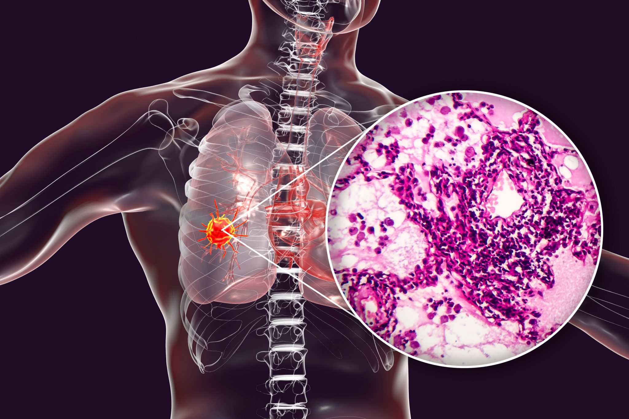 Proteomic Map Of Human Lung Adenocarcinoma Revealed