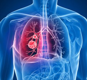 New biomarker identified for early diagnosis of lung cancer