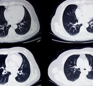lung cancer